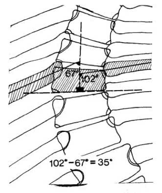 Infantile Scoliosis: Early Signs and Specialist Care — supporting illustration