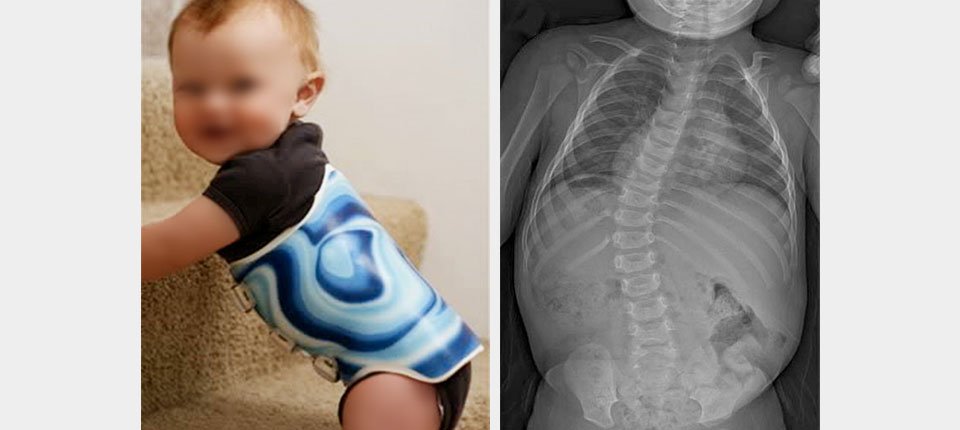 Infantile Scoliosis: Early Signs and Specialist Care — supporting illustration